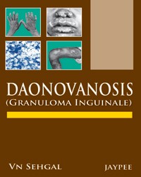 Donovanosis (Granuloma Inguinale)